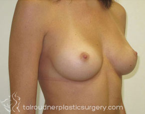 Breast Augmentation