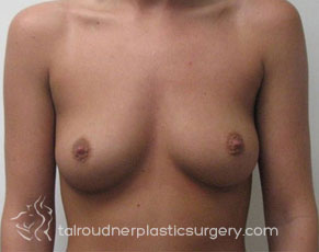 Breast Augmentation