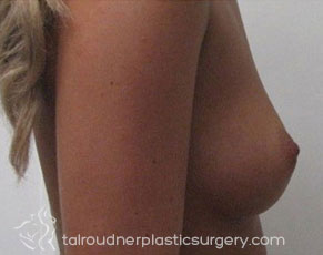 Breast Augmentation