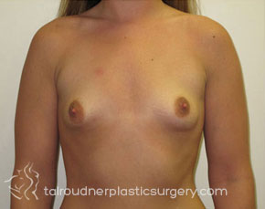 Breast Augmentation