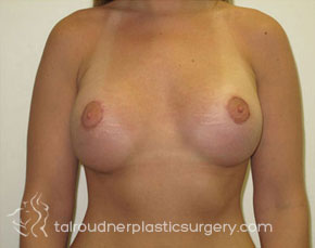 Breast Augmentation