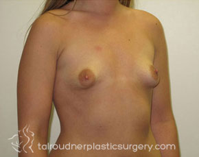 Breast Augmentation