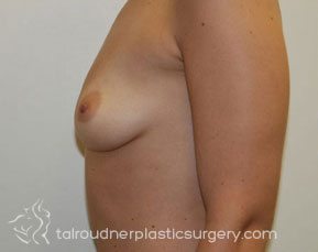 Breast Augmentation