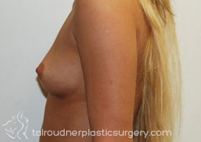 Breast Augmentation