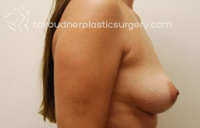 Breast Augmentation