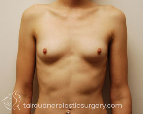 Breast Augmentation