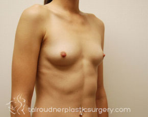 Breast Augmentation