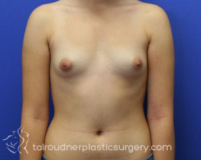 Breast Augmentation