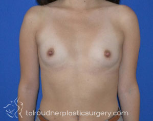Breast Augmentation