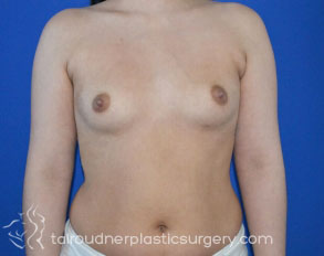 Breast Augmentation
