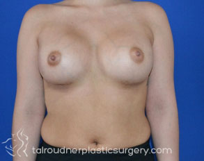 Breast Augmentation
