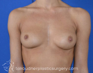 Breast Augmentation