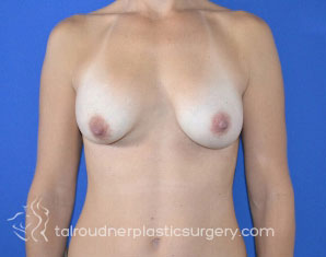 Breast Augmentation