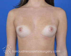 Breast Augmentation