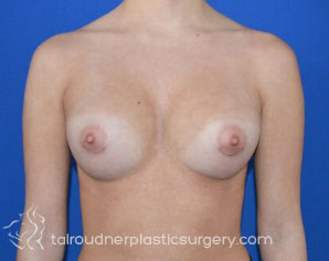 Breast Augmentation