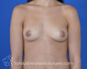 Breast Augmentation