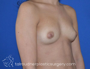 Breast Augmentation