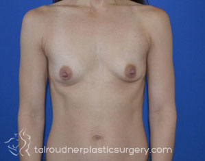 Breast Augmentation