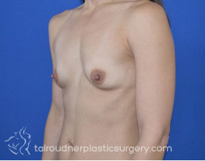 Breast Augmentation