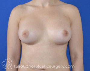 Breast Augmentation