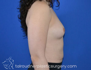 Breast Augmentation