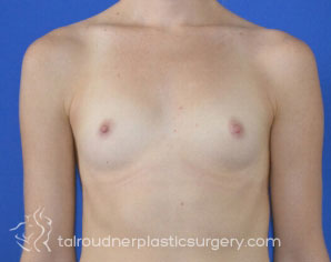 Breast Augmentation