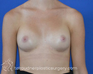 Breast Augmentation