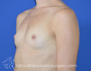 Breast Augmentation