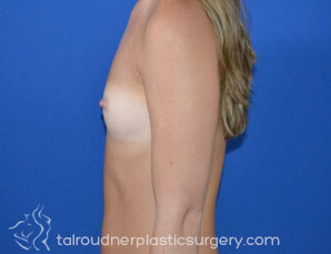 Breast Augmentation