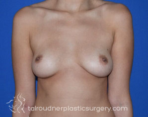 Breast Augmentation