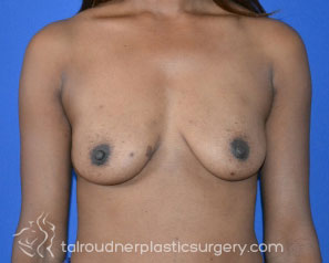 Breast Augmentation
