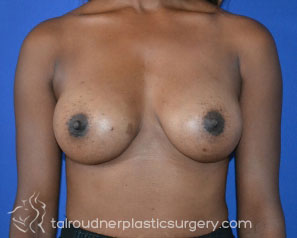 Breast Augmentation