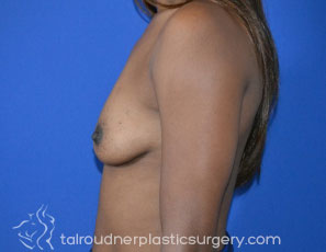 Breast Augmentation