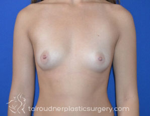 Breast Augmentation