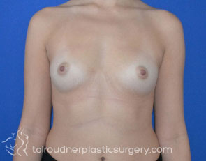 Breast Augmentation