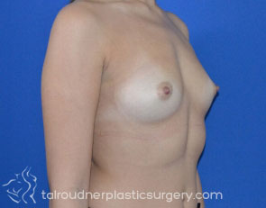 Breast Augmentation