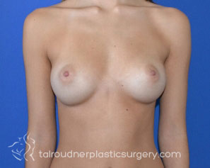 Breast Augmentation