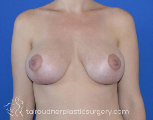 Breast Lift