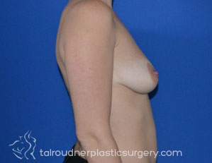 Breast Lift