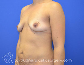 Breast Lift