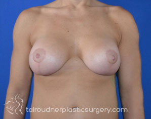 Breast Lift