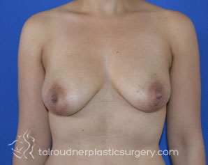 Breast Lift