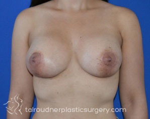 Breast Lift