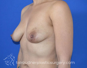 Breast Lift
