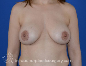 Breast Lift