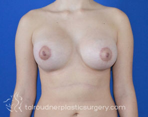 Breast Lift