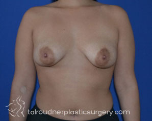 Breast Lift