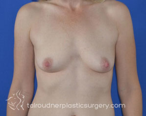 Breast Lift