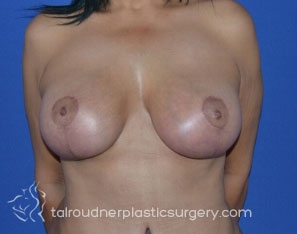 Breast Lift