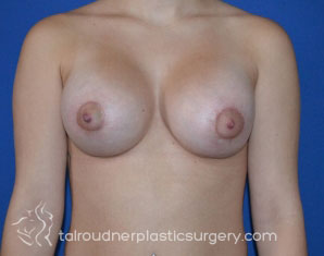 Breast Lift